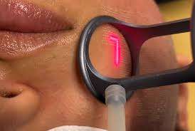 Laser CO2 Fractional RF Technician